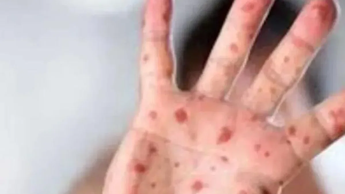 Maymun Çiçeği virüsüne karşı en dikkatli olması gereken sektör: Turizm